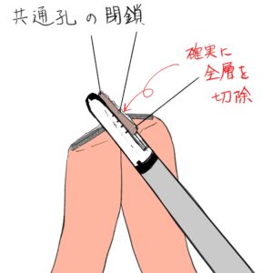 機能的端々吻合　イラスト　手順　方法　FEEA