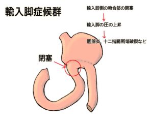 輸入脚症候群