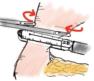 デルタ吻合　イラスト