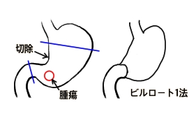 ビルロート1法　Billroth I B1 胃切除　再建　吻合